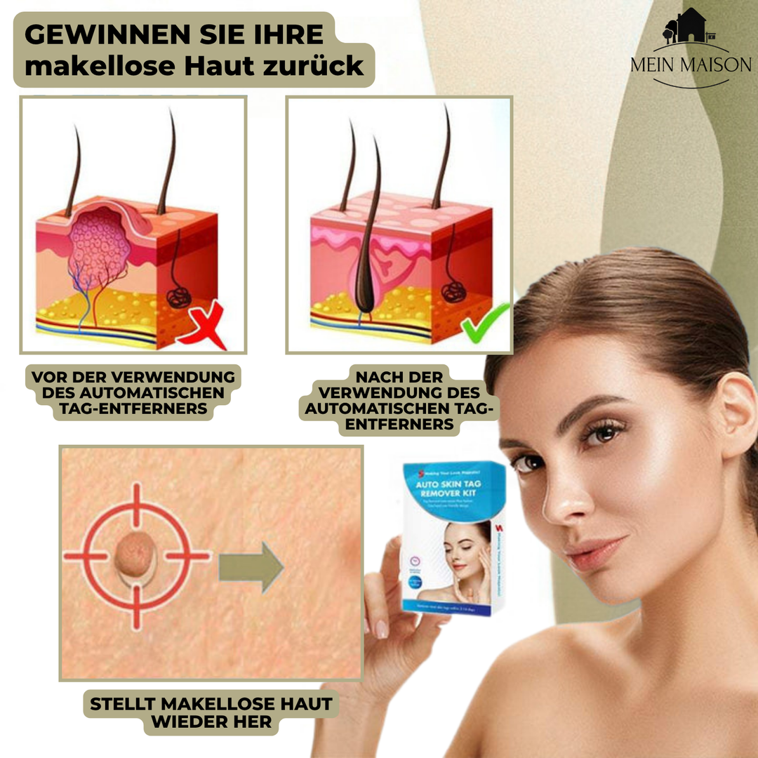 Skanto | DermaLinx Warzenentferner | Schmerzfreie Entfernung von Warzen und Muttermalen | Für den Heimgebrauch | Ohne Operation