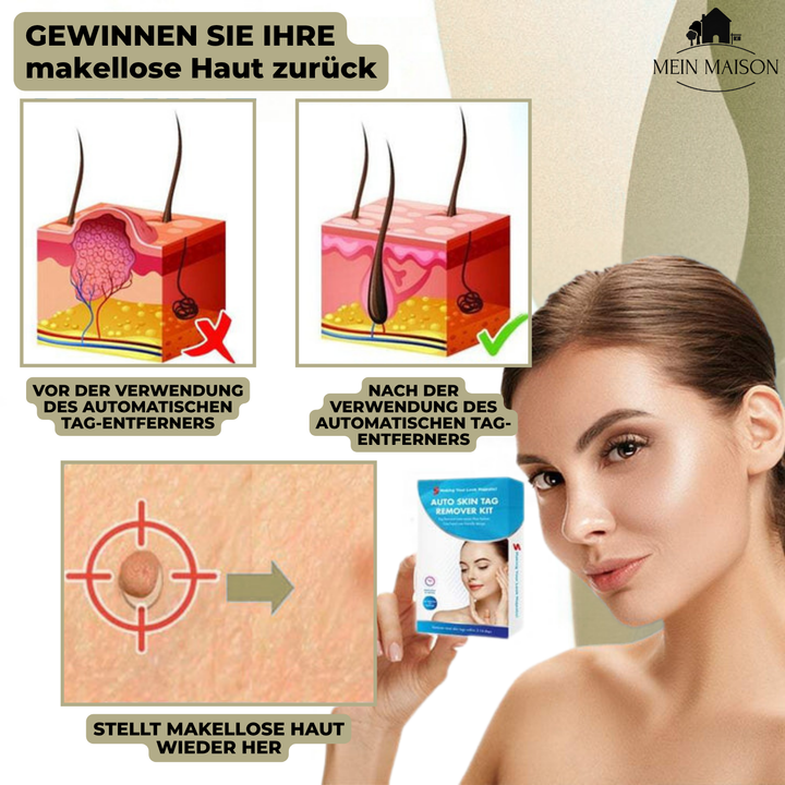 Skanto | DermaLinx Warzenentferner | Schmerzfreie Entfernung von Warzen und Muttermalen | Für den Heimgebrauch | Ohne Operation