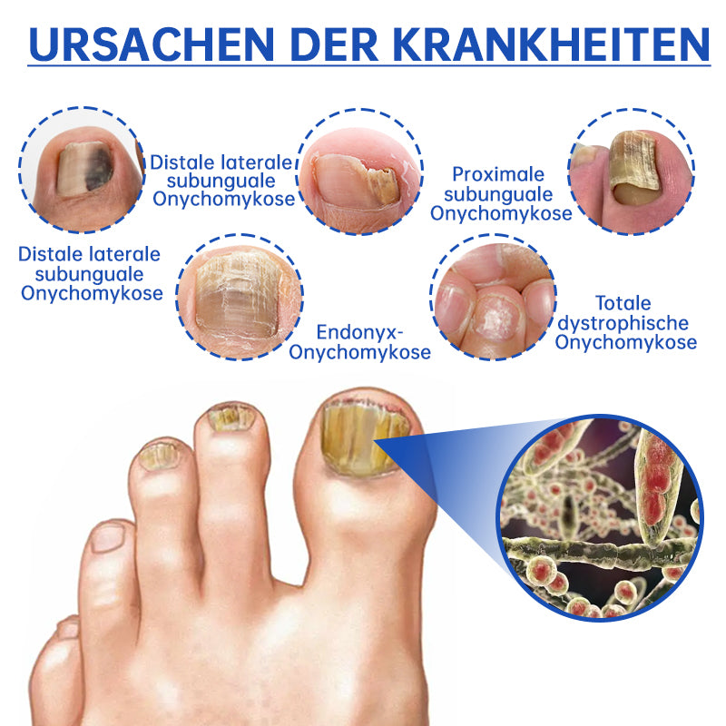 Skanto | PureNail™ | Nagelpfliz-Laserbehandlungsgerät – Ihre Geheimwaffe gegen Nagelpilz