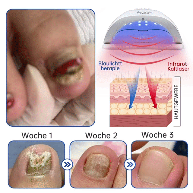 Skanto | PureNail™ | Nagelpfliz-Laserbehandlungsgerät – Ihre Geheimwaffe gegen Nagelpilz