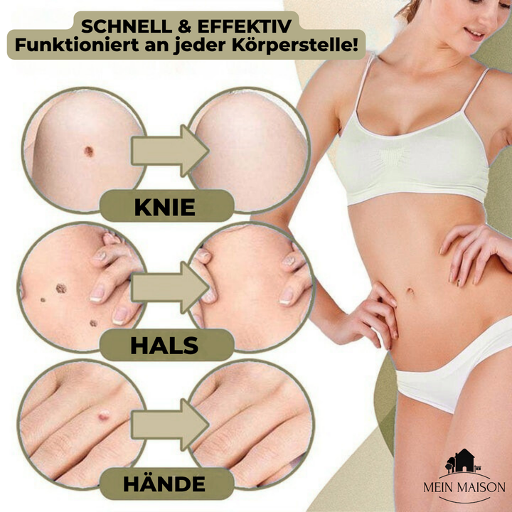 Skanto | DermaLinx Warzenentferner | Schmerzfreie Entfernung von Warzen und Muttermalen | Für den Heimgebrauch | Ohne Operation