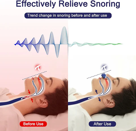 Skanto | Micro CPAP Anti-Schnarch-Gerät | Maskenfreie Schlafapnoe-Behandlung