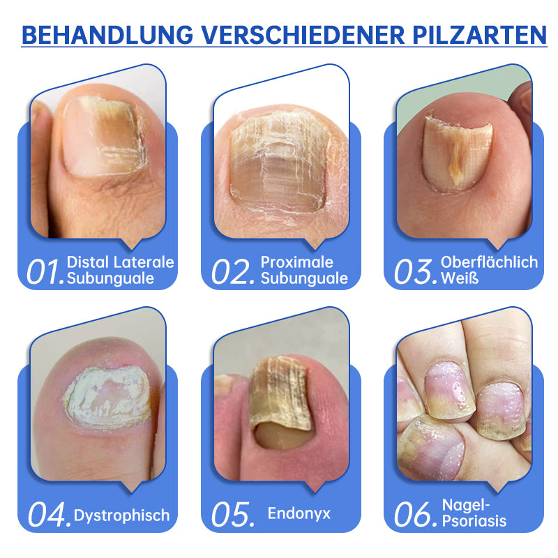 Skanto | PureNail™ | Nagelpfliz-Laserbehandlungsgerät – Ihre Geheimwaffe gegen Nagelpilz
