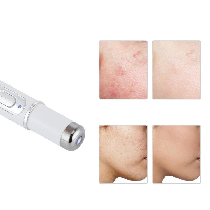 Skanto | LUCY – Blaulicht-Laserstift für präzise Behandlung