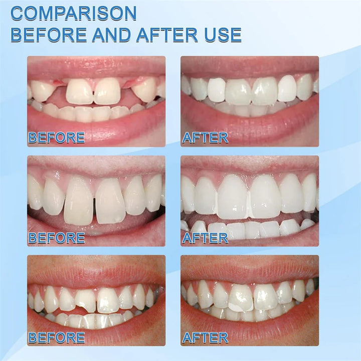 Skanto | ToothTite – Temporäres Zahnreparaturmaterial (1+1 Gratis!)