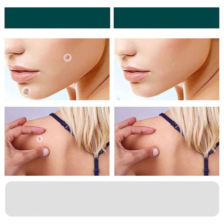 Skanto | SkinClear - Pflaster zur Entfernung von Flecken und Warzen