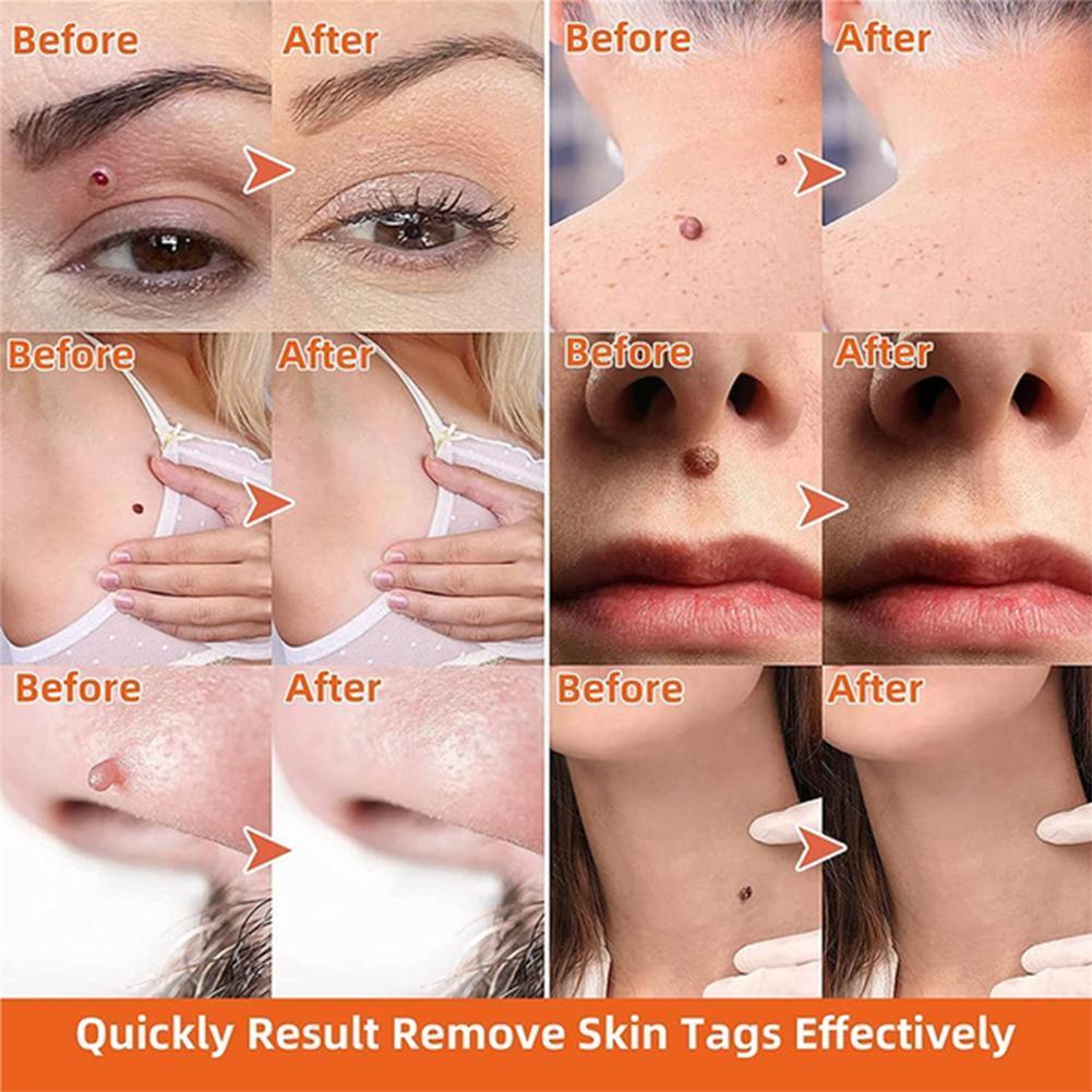 Skanto | Auto Skin Tag Entferner Schmerzfrei