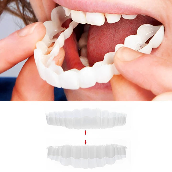 Skanto | Abnehmbare Zahn-Veneers für Ober- und Unterkiefer