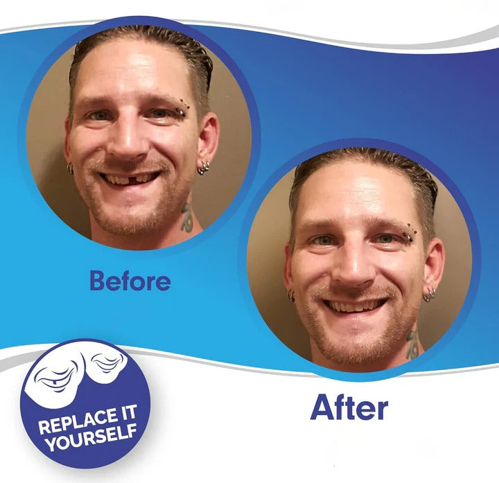 Skanto | Abnehmbare Zahn-Veneers für Ober- und Unterkiefer