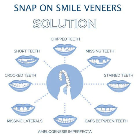 Skanto | Abnehmbare Zahn-Veneers für Ober- und Unterkiefer