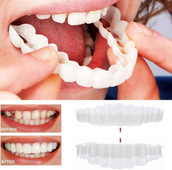 Skanto | Abnehmbare Zahn-Veneers für Ober- und Unterkiefer