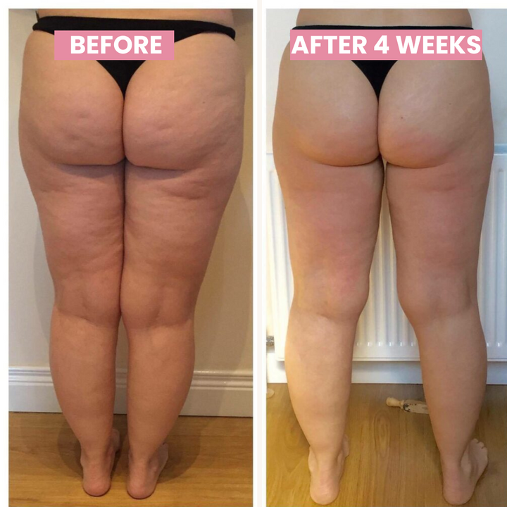 Skanto | SlimCupp Anti-Cellulite-Schröpfgerät